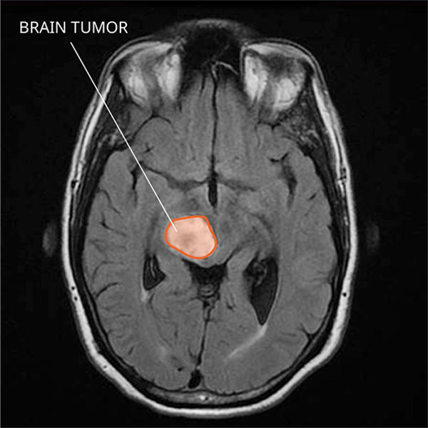 brain tumor