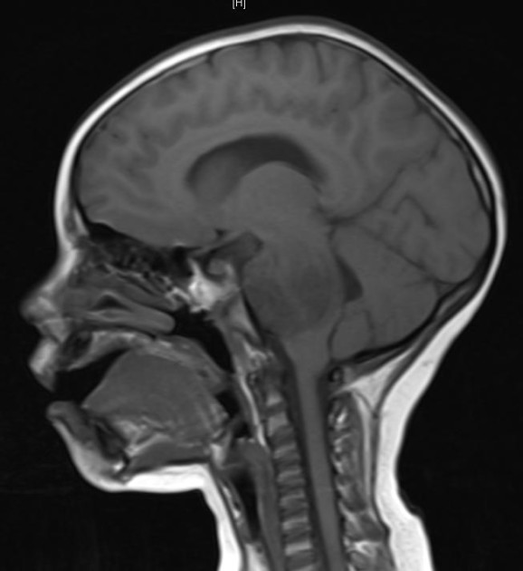 childhood brain tumor